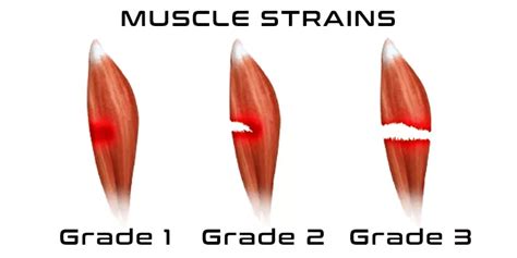 grade one muscle tear